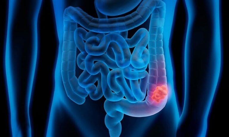 PREVENIBLE EL CÁNCER DE COLON: IMSS VERACRUZ SUR